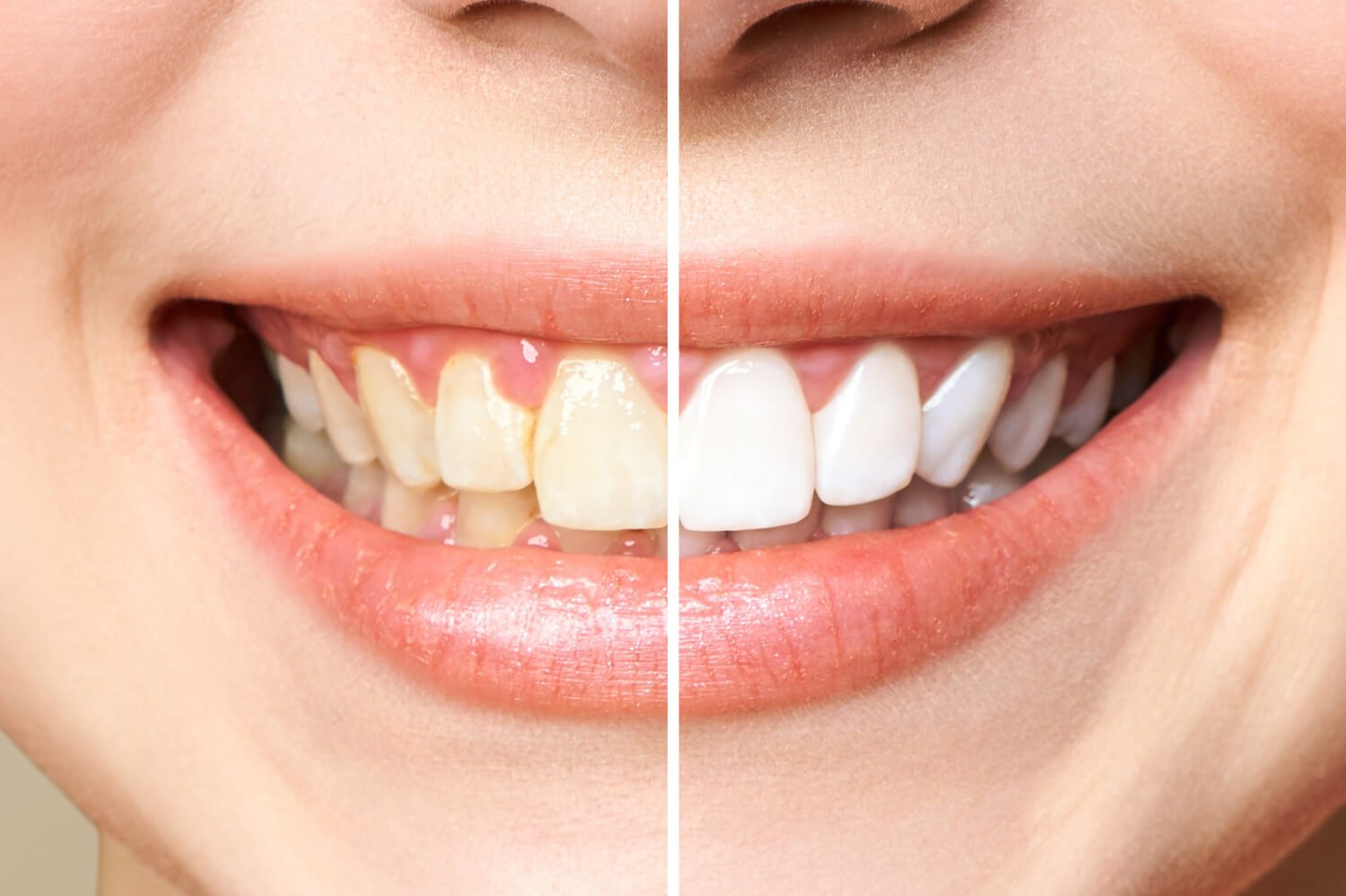Clareamento dentário